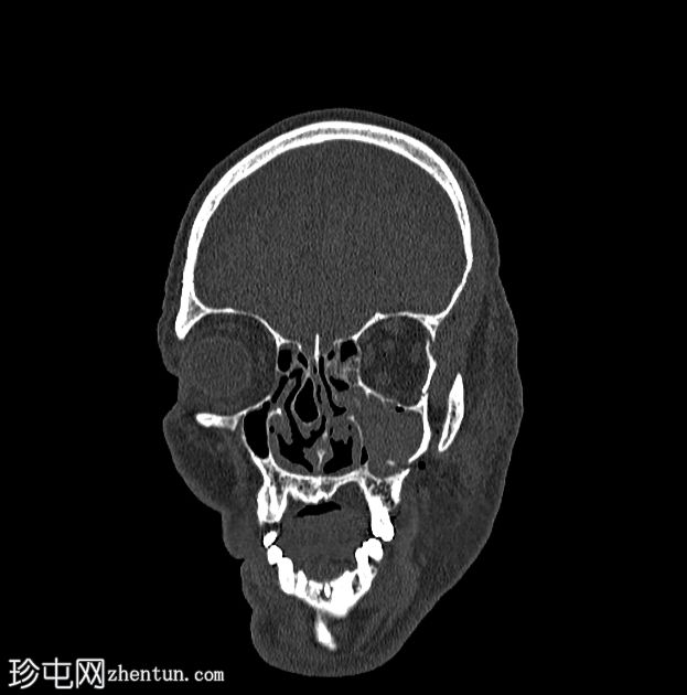 三脚架面断裂