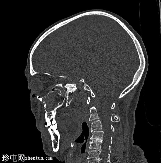 三脚架面断裂