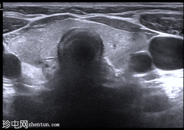 高回声甲状旁腺腺瘤（脂肪腺瘤）