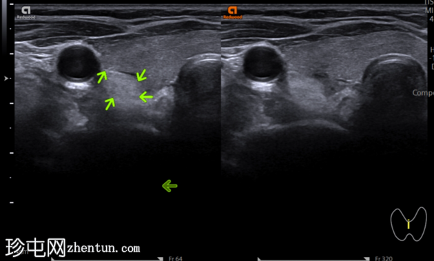 高回声甲状旁腺腺瘤（脂肪腺瘤）