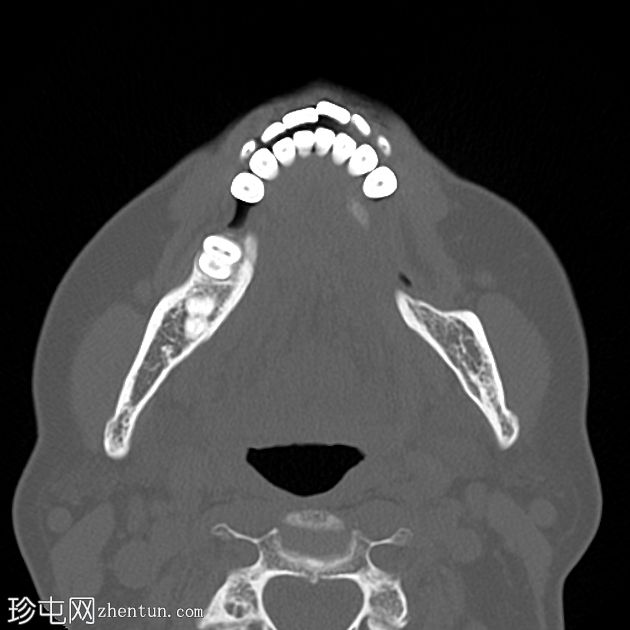 慢性骨髓炎-下颌骨