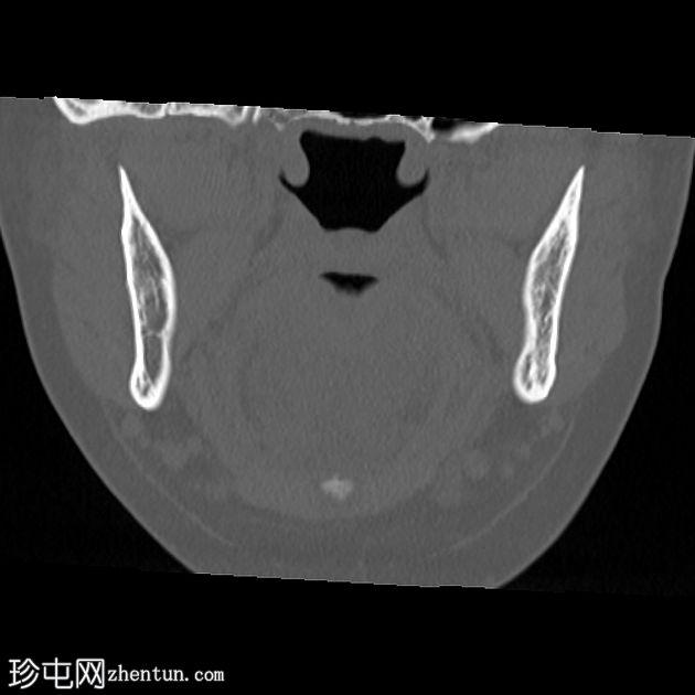 慢性骨髓炎-下颌骨
