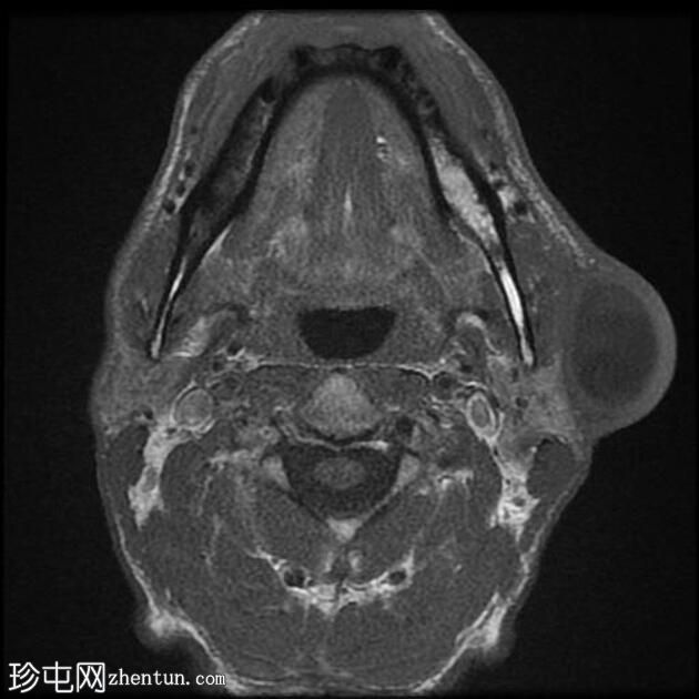 感染性第一鳃裂囊肿