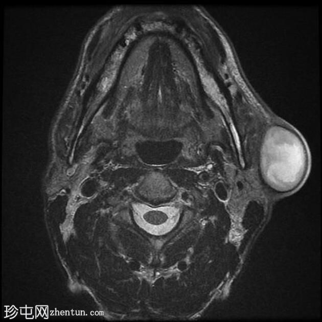 感染性第一鳃裂囊肿