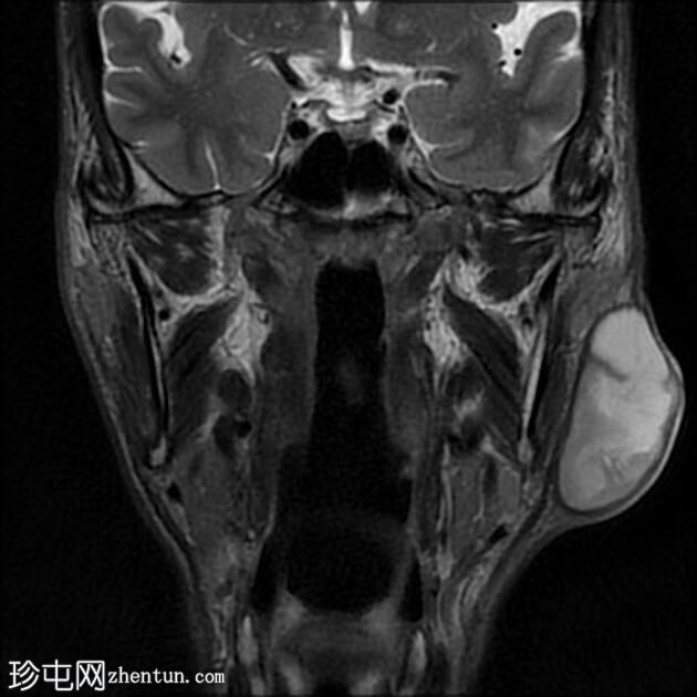 感染性第一鳃裂囊肿