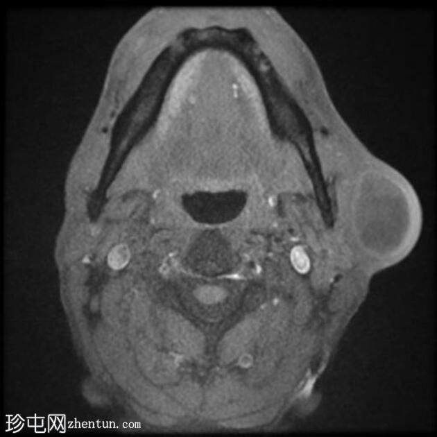 感染性第一鳃裂囊肿