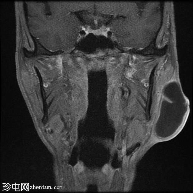 感染性第一鳃裂囊肿