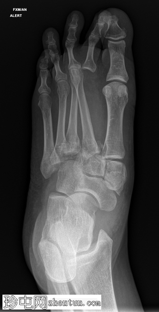 Lisfranc 骨折和脱位