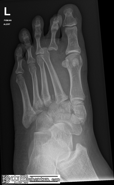 Lisfranc 骨折和脱位