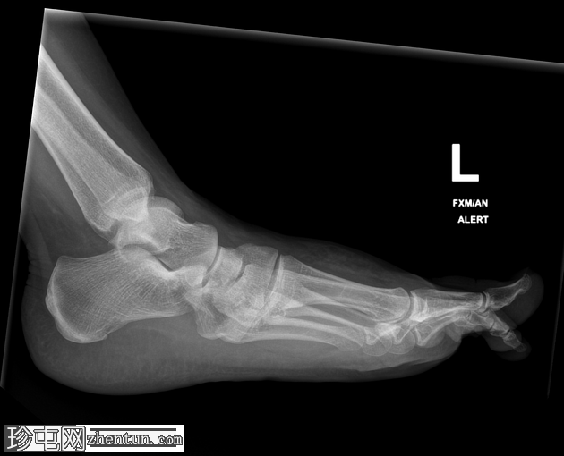 Lisfranc 骨折和脱位