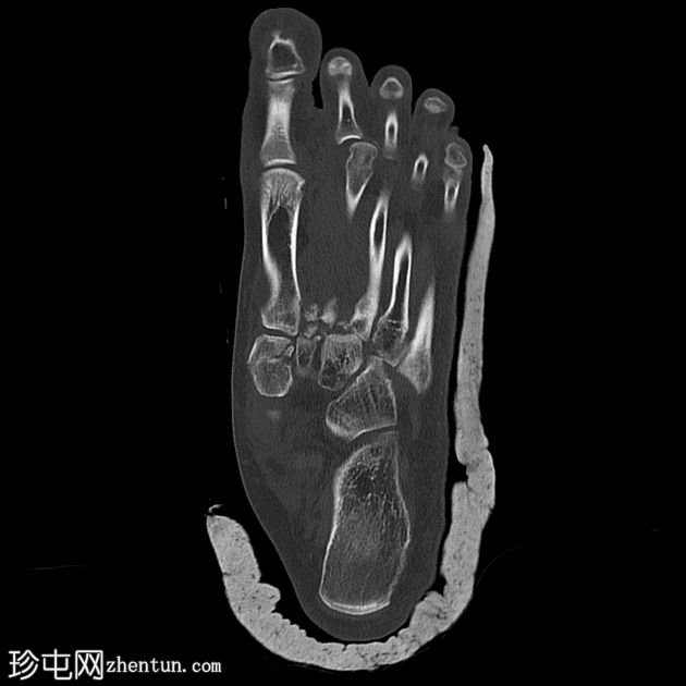 Lisfranc 骨折和脱位