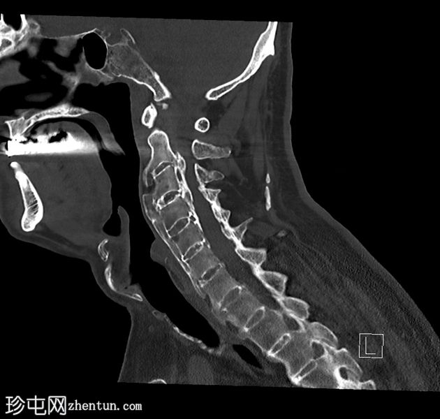 弥漫性特发性骨质增生及后纵韧带骨化