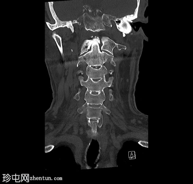 弥漫性特发性骨质增生及后纵韧带骨化