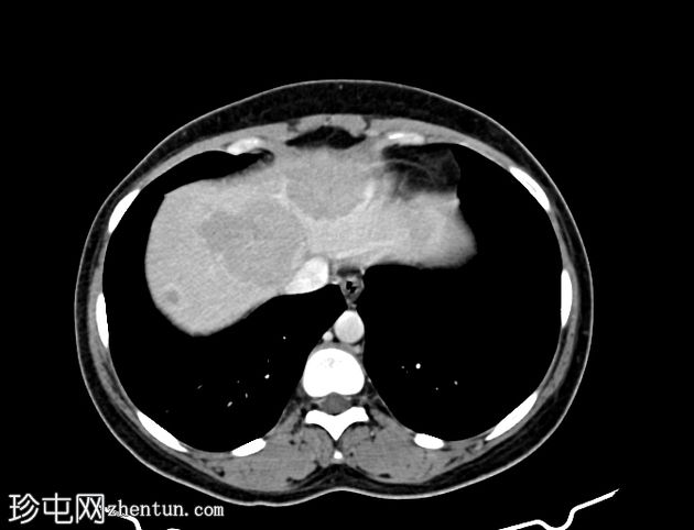 肝细胞癌 - 巨大且多灶性