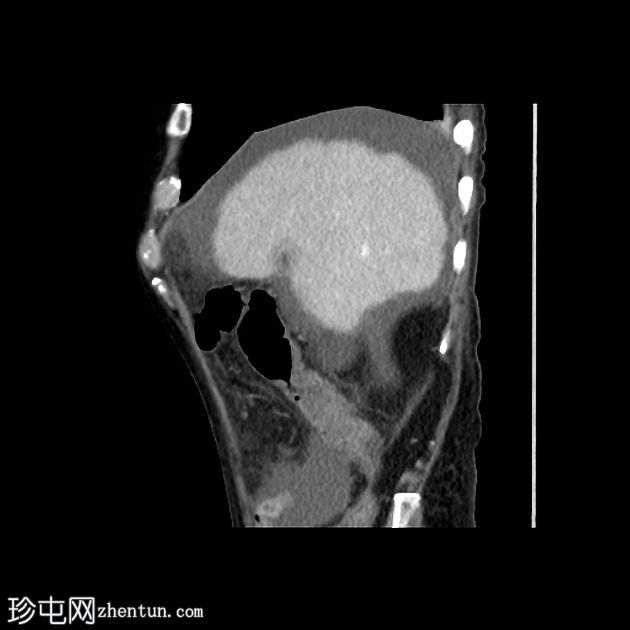 多灶性肝细胞癌（三期 CT）