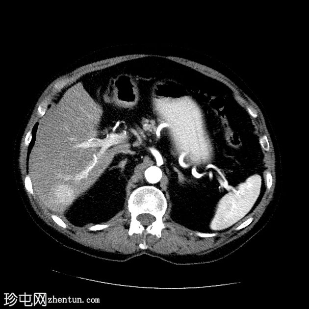 肝细胞癌 - CT 和 MRI