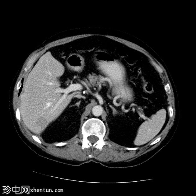 肝细胞癌 - CT 和 MRI