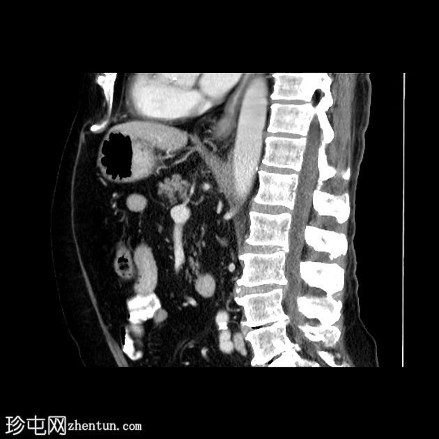 肝细胞癌 - CT 和 MRI