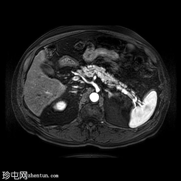 肝细胞癌 - CT 和 MRI