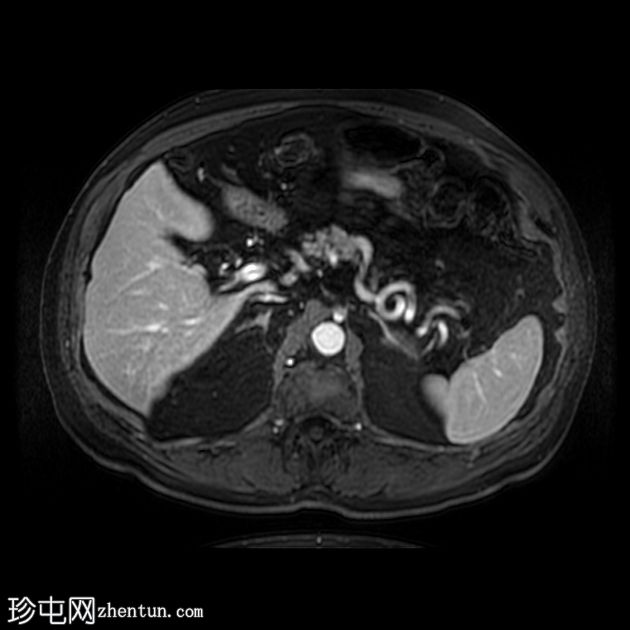 肝细胞癌 - CT 和 MRI