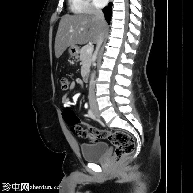 胃腺癌-腺病