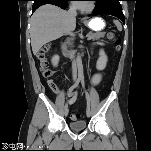 回肠末端类癌瘤 - 恶性梗阻超声引导下活检