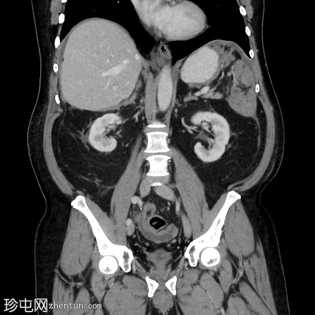 间皮瘤 - 恶性腹膜