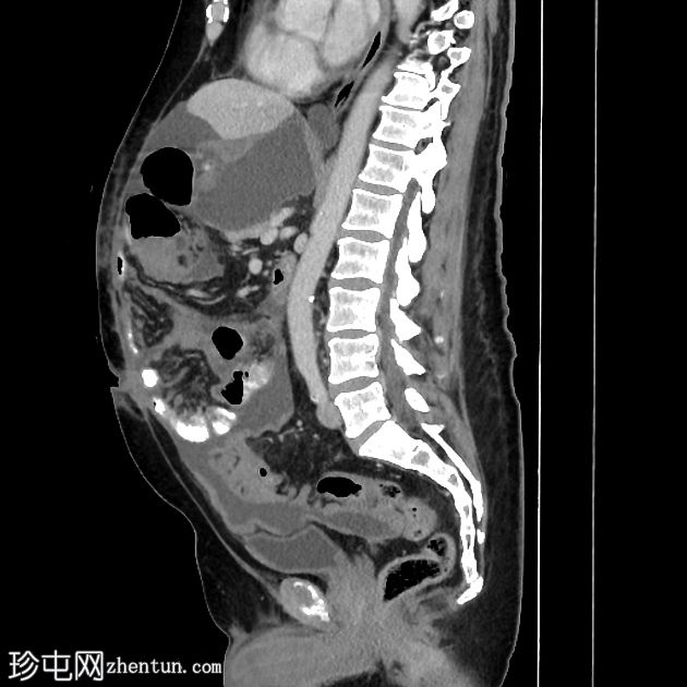 间皮瘤 - 恶性腹膜