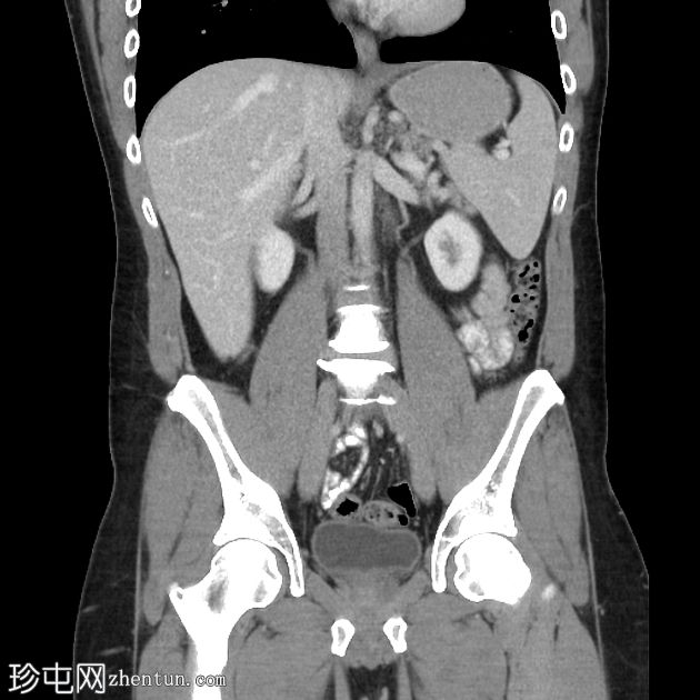 良性囊性间皮瘤