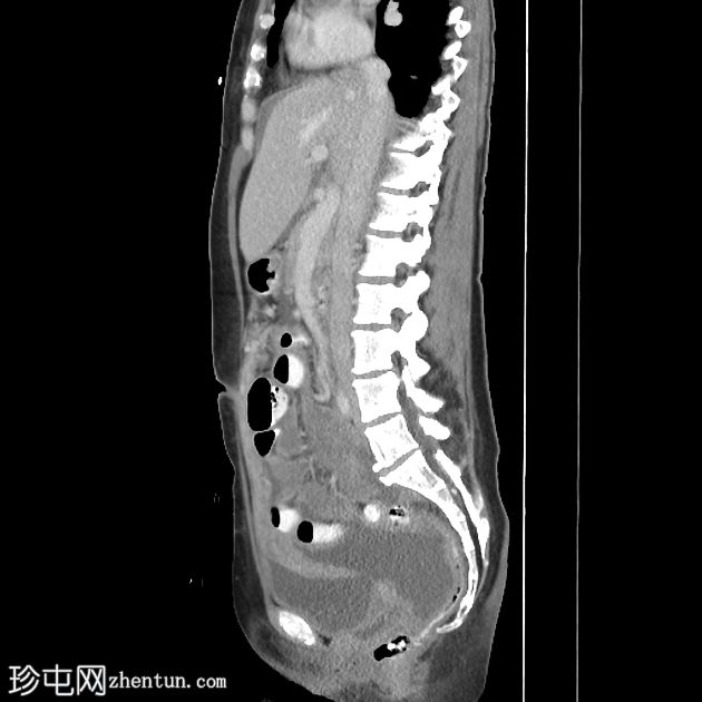 间皮瘤 - 恶性腹膜，活检