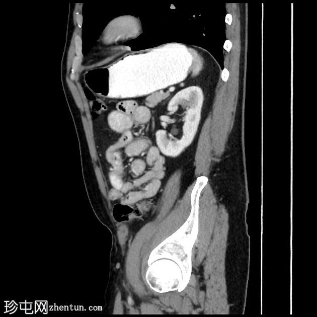 回肠类癌（神经内分泌）肿瘤