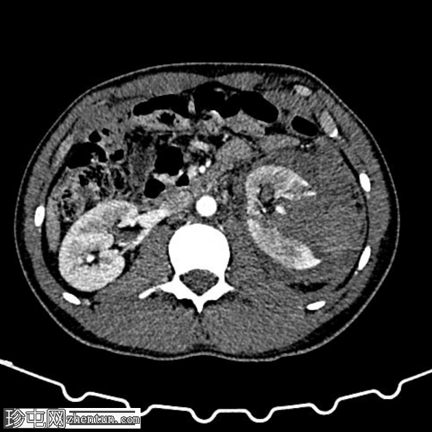 腹部钝性创伤伴有肾脏损伤