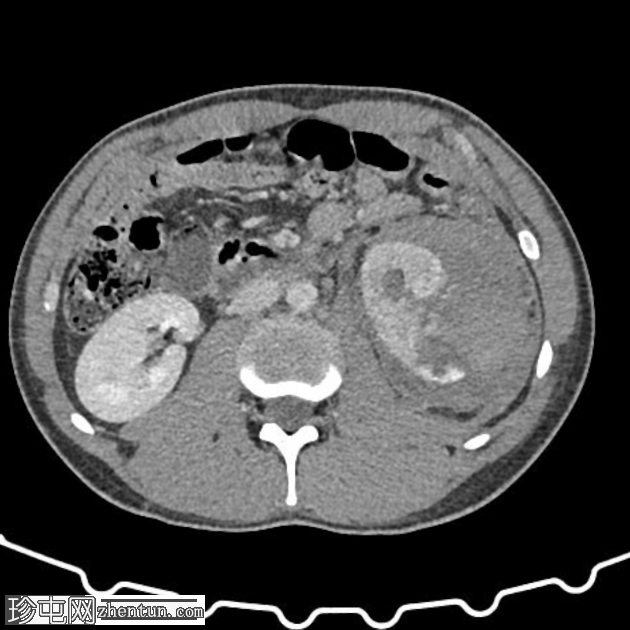 腹部钝性创伤伴有肾脏损伤