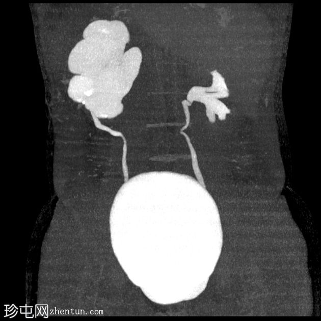 输尿管肾盂造口术