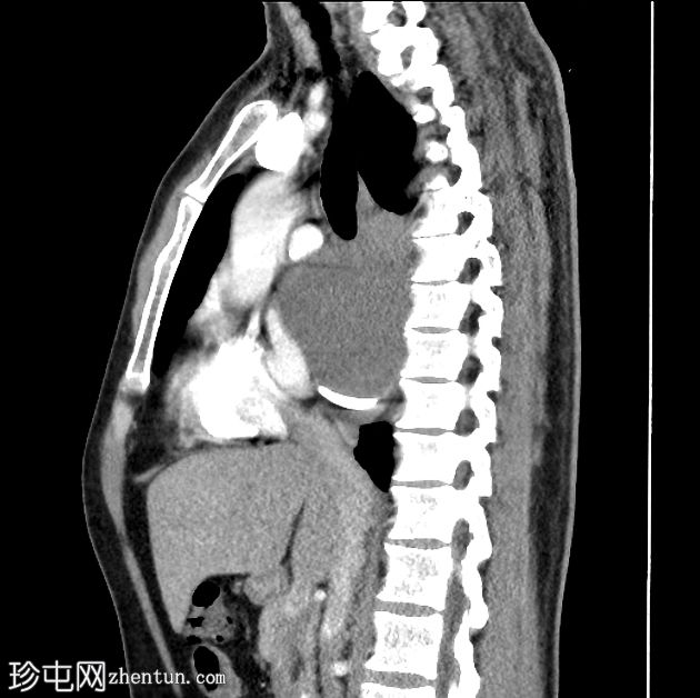 支气管囊肿