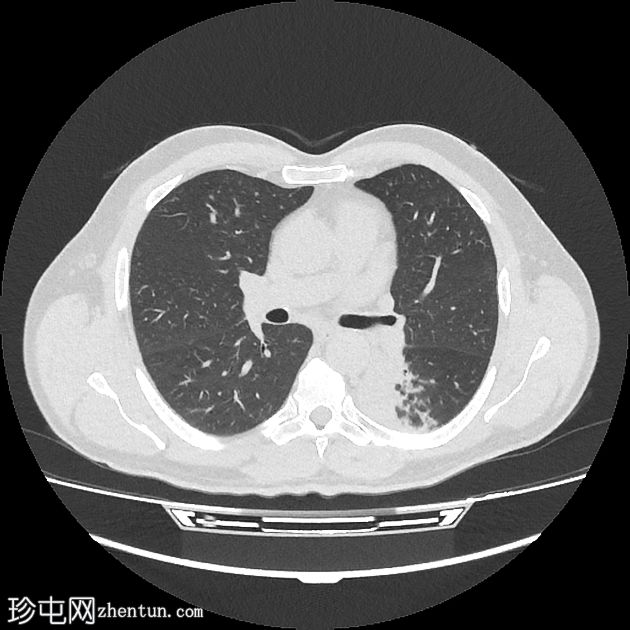 支气管内脂肪瘤