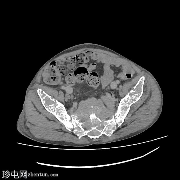 重型地中海贫血-髓外造血和血色素沉着症