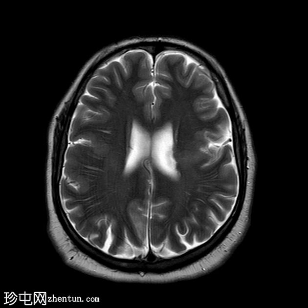 裂脑畸形-闭唇型