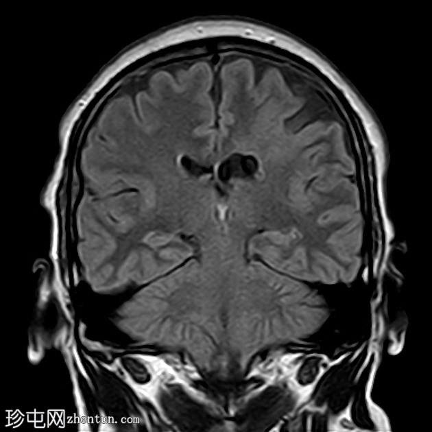 裂脑畸形-闭唇型