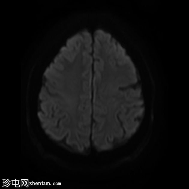 裂脑畸形-闭唇型