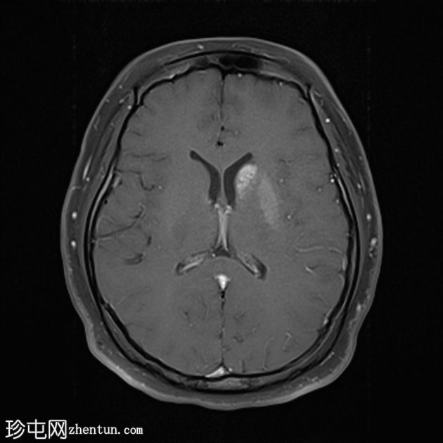 非酮症高血糖性偏侧舞蹈症