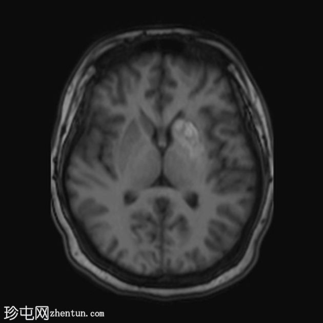 非酮症高血糖性偏侧舞蹈症