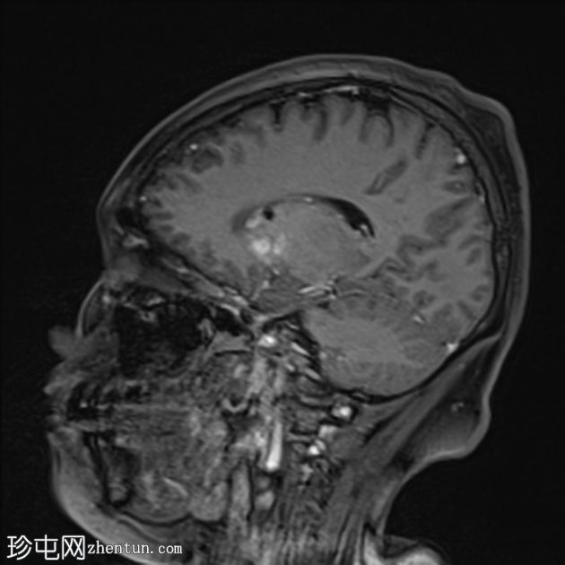 非酮症高血糖性偏侧舞蹈症