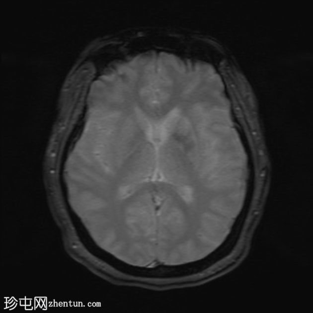 非酮症高血糖性偏侧舞蹈症