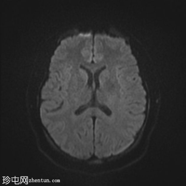 非酮症高血糖性偏侧舞蹈症