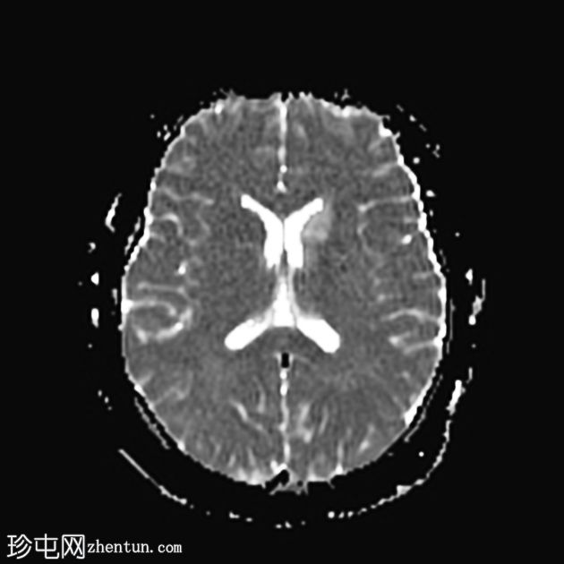 非酮症高血糖性偏侧舞蹈症