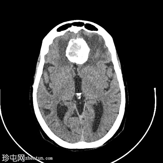 脑膜瘤 - 严重钙化