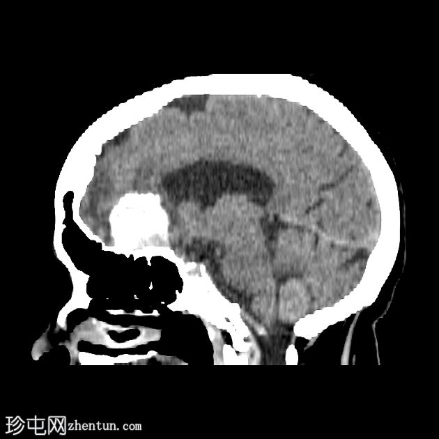 脑膜瘤 - 严重钙化
