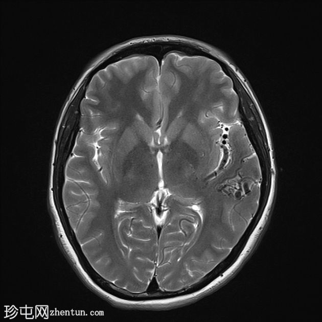 脑动静脉畸形