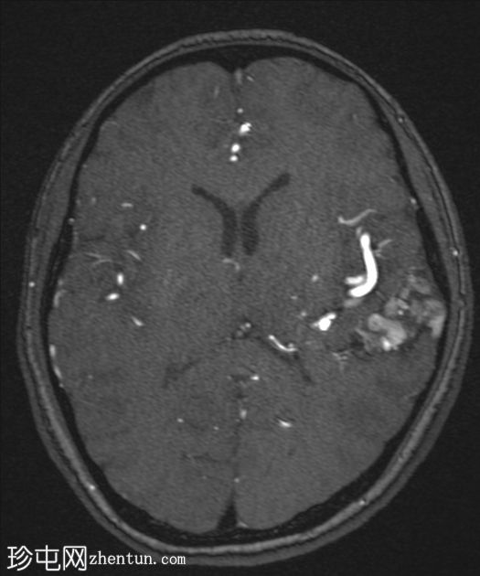 脑动静脉畸形